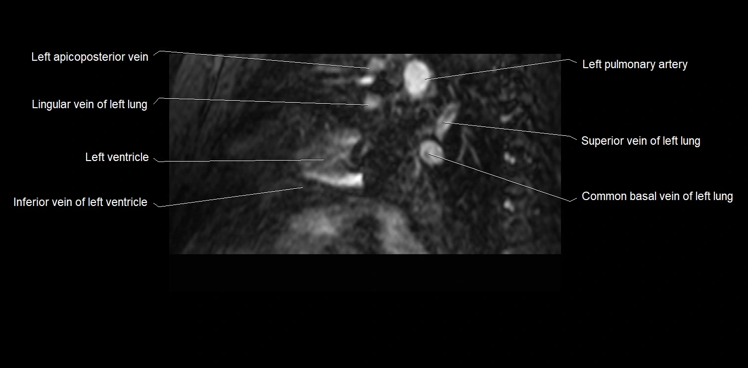 MRI heart and coronary arteries two chamber(sagittal)  anatomy image 39.webp
